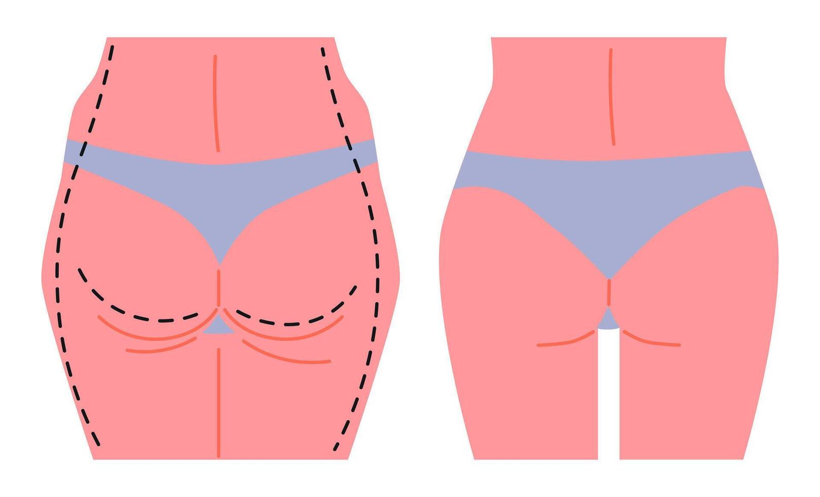 Liposuction Surgery Before and After Comparison. vector