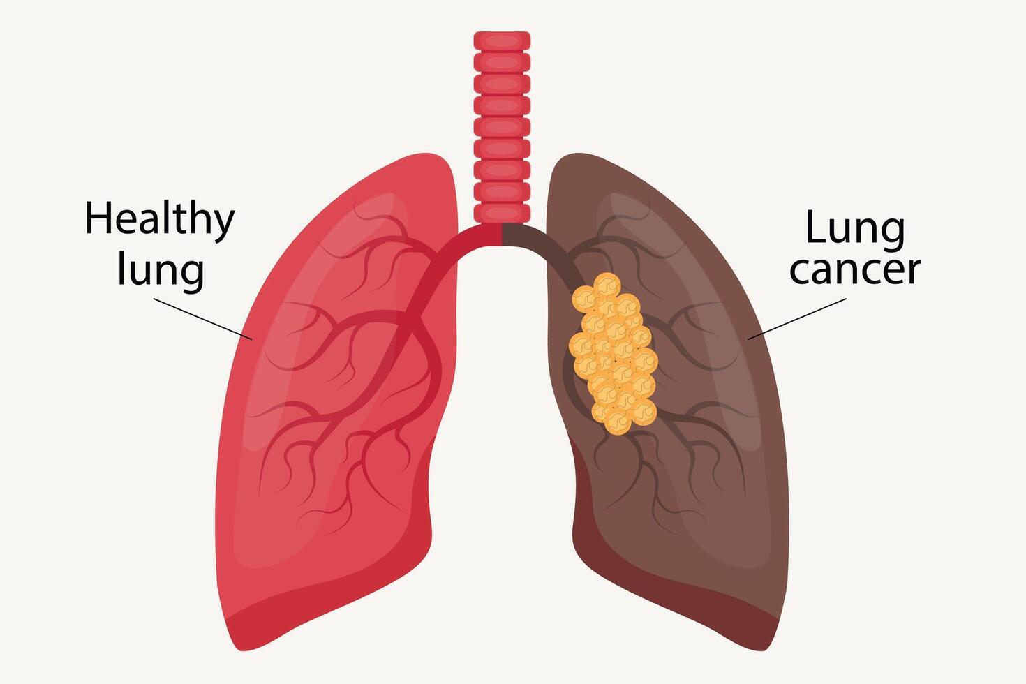 Illustration of healthy lung and lung cancer. vector