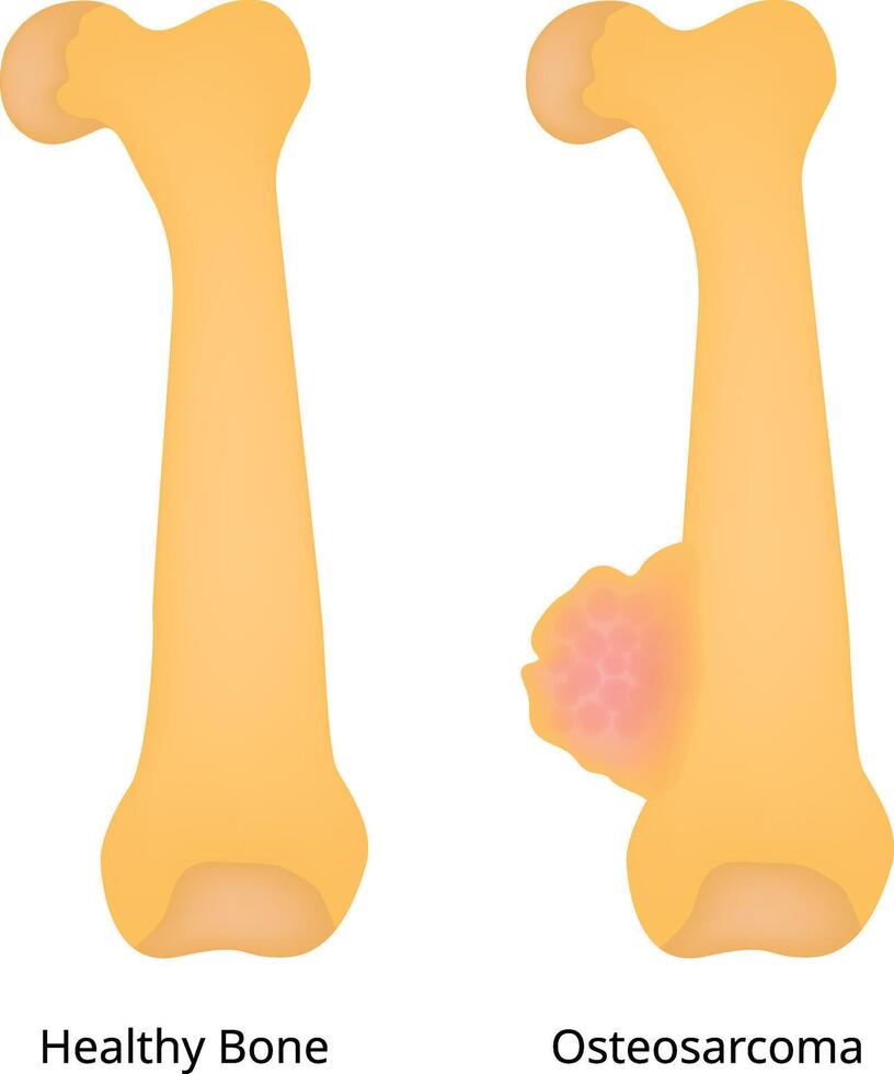 Healthy Bone Osteosarcoma Science Design Illustration Diagram vector