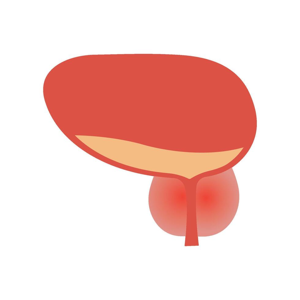 Prostatitis swelling and inflammation of prostate gland.Disease and pain in the human male body. Bladder anatomy vector