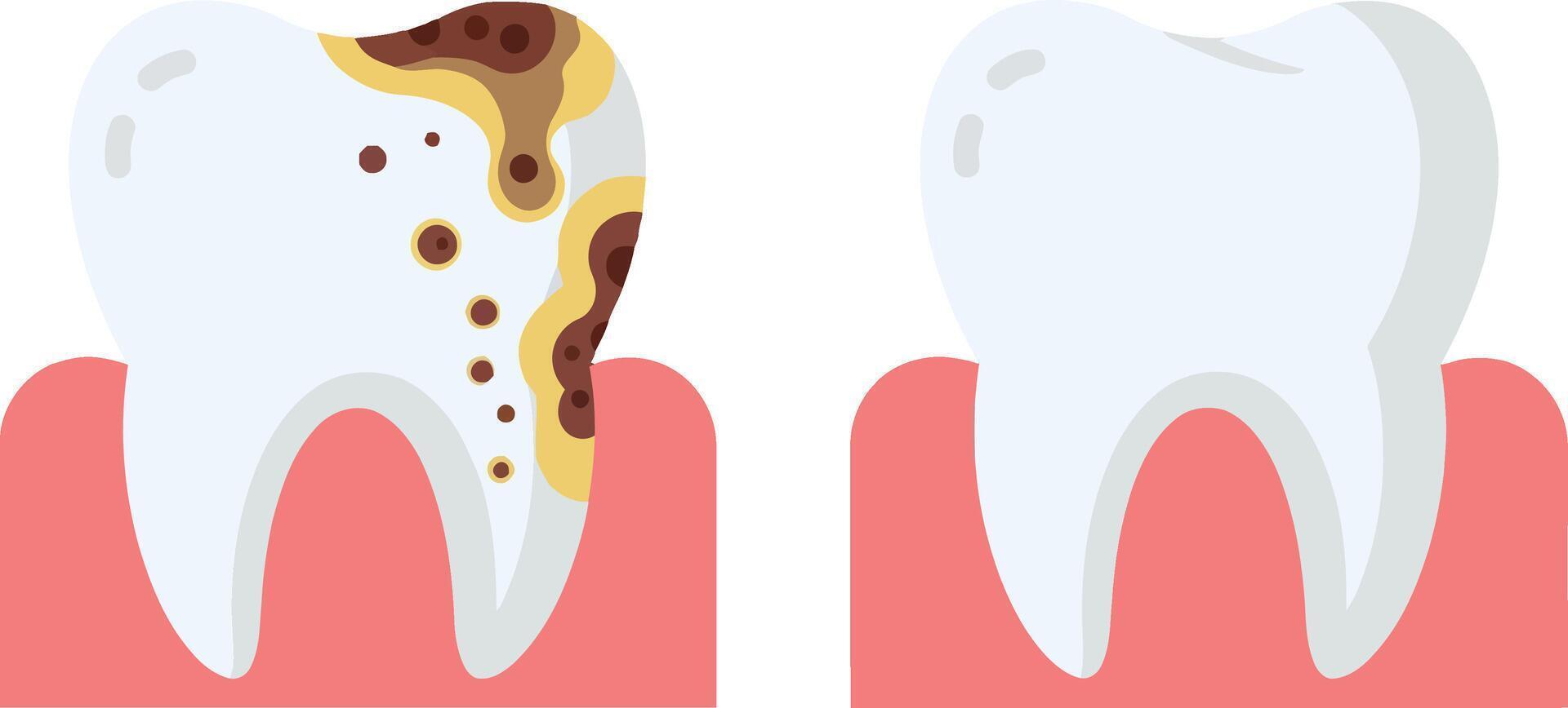 Two dental illustrations showcasing a healthy tooth alongside a decayed tooth in a flat design style, emphasizing dental health and hygiene in art vector