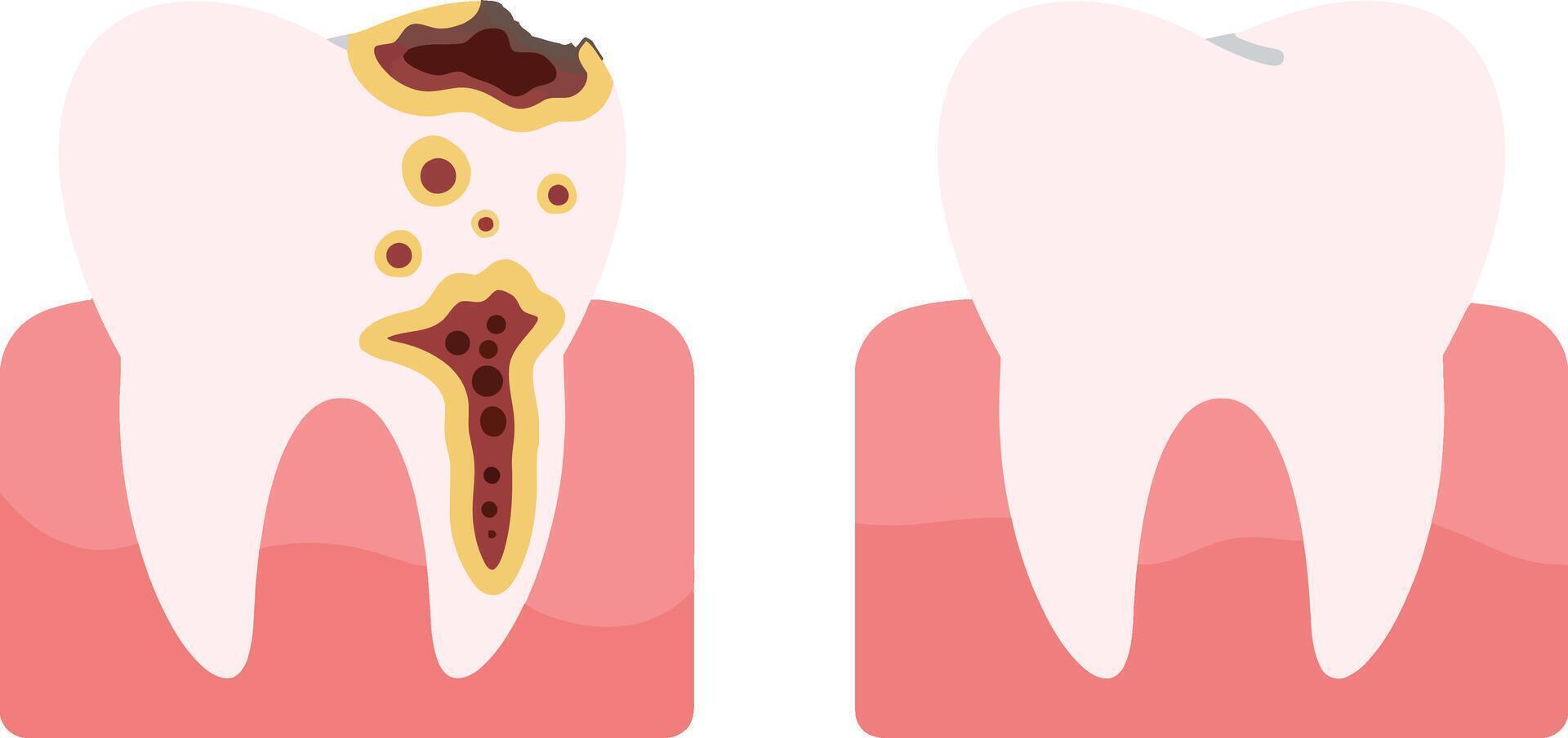 Tooth illustration showcasing dental decay on one side and a healthy tooth on the other side in minimalist art vector