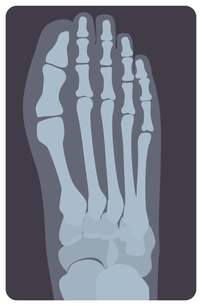 Superior radiograph of human right foot or limb. X-ray picture or radiographic monitor image of metatarsus bones and toes, top view. Medical radiology. Monochrome illustration in flat style vector