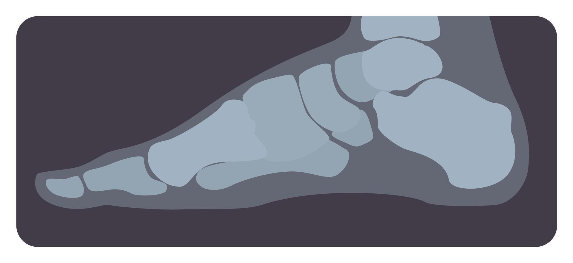 Lateral radiograph of human foot or limb. X-ray picture or radiographic image of metatarsus bones and toes, side view. Modern medical radiography. Monochrome illustration in flat cartoon style vector