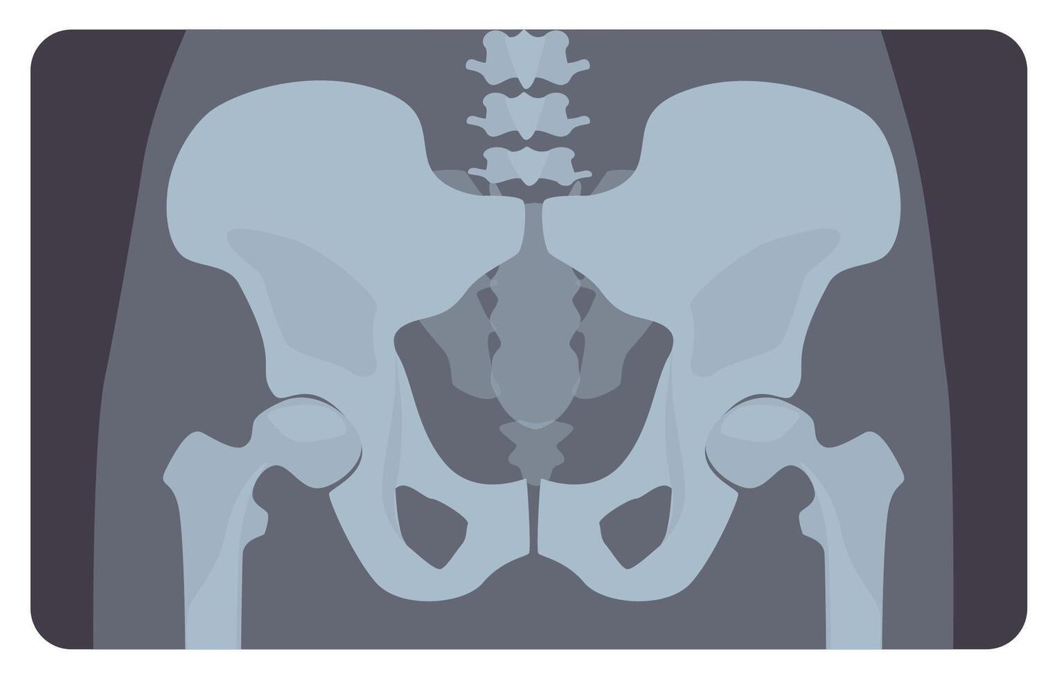 Anterior radiograph of human pelvis or hip bone with lumbar part. X-ray picture or image of human skeletal system, front view. Medical disease detection. illustration in flat cartoon style vector