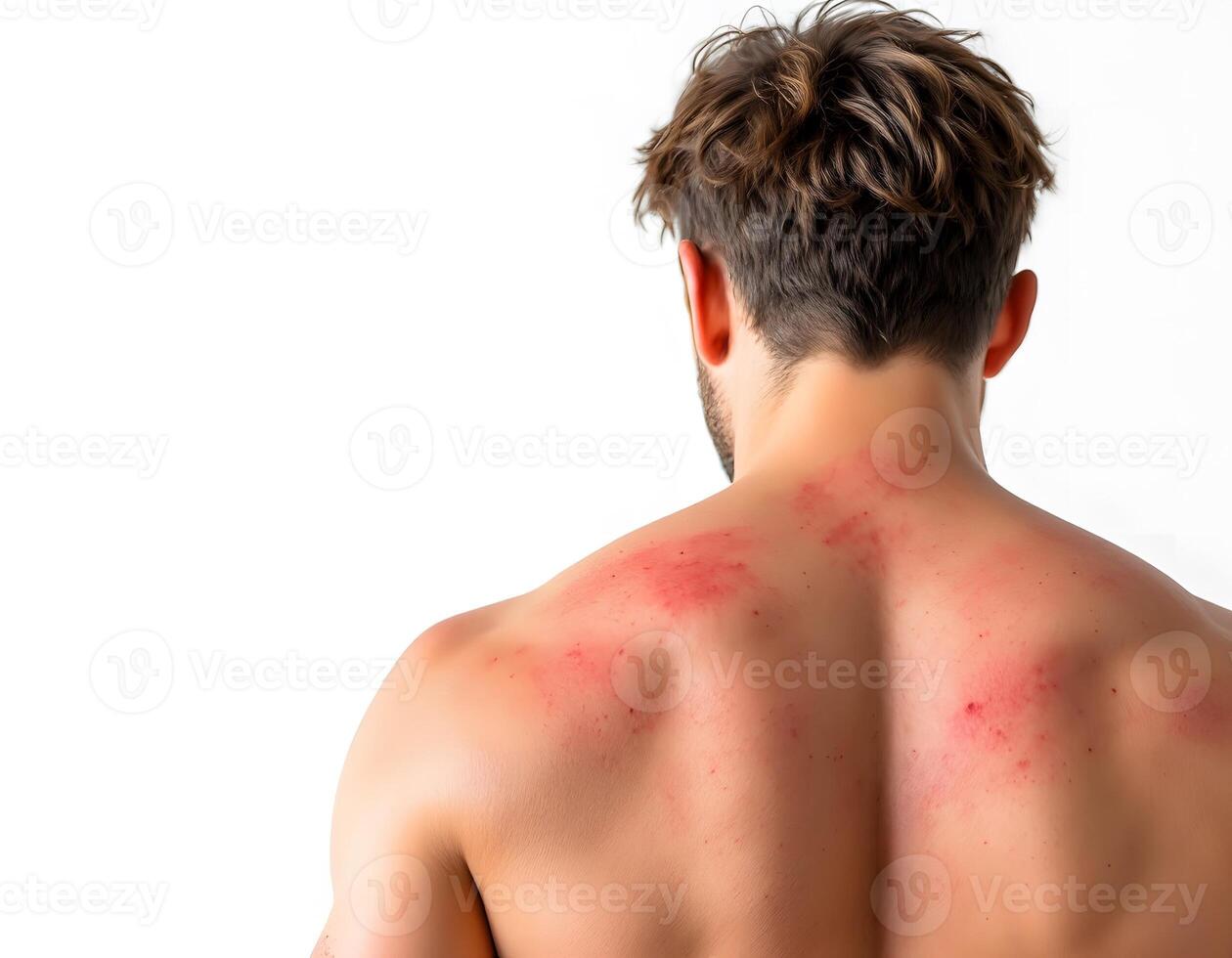 Man's Back with Sunburn or Rash Medical Image photo