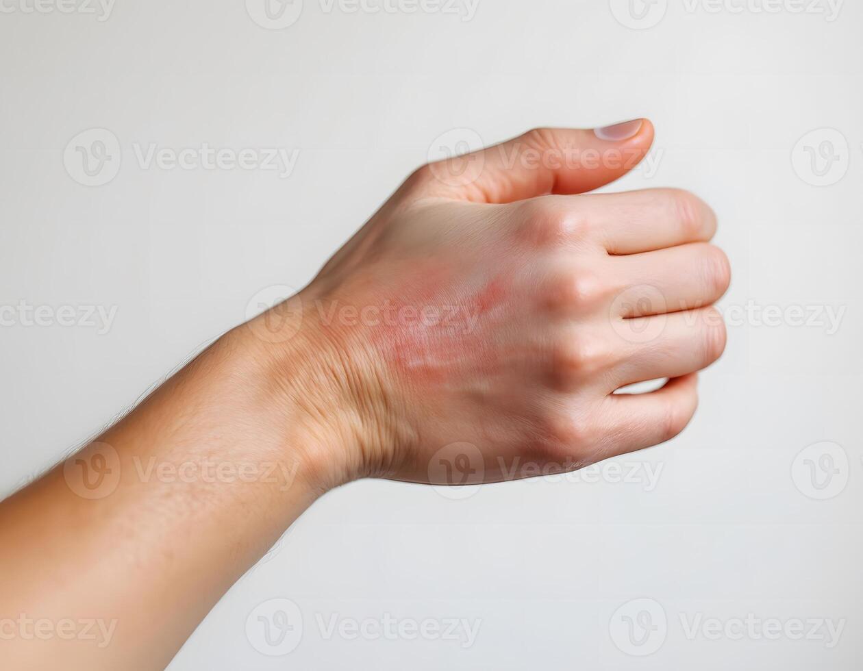 Burn Injury on Hand A Medical Image photo