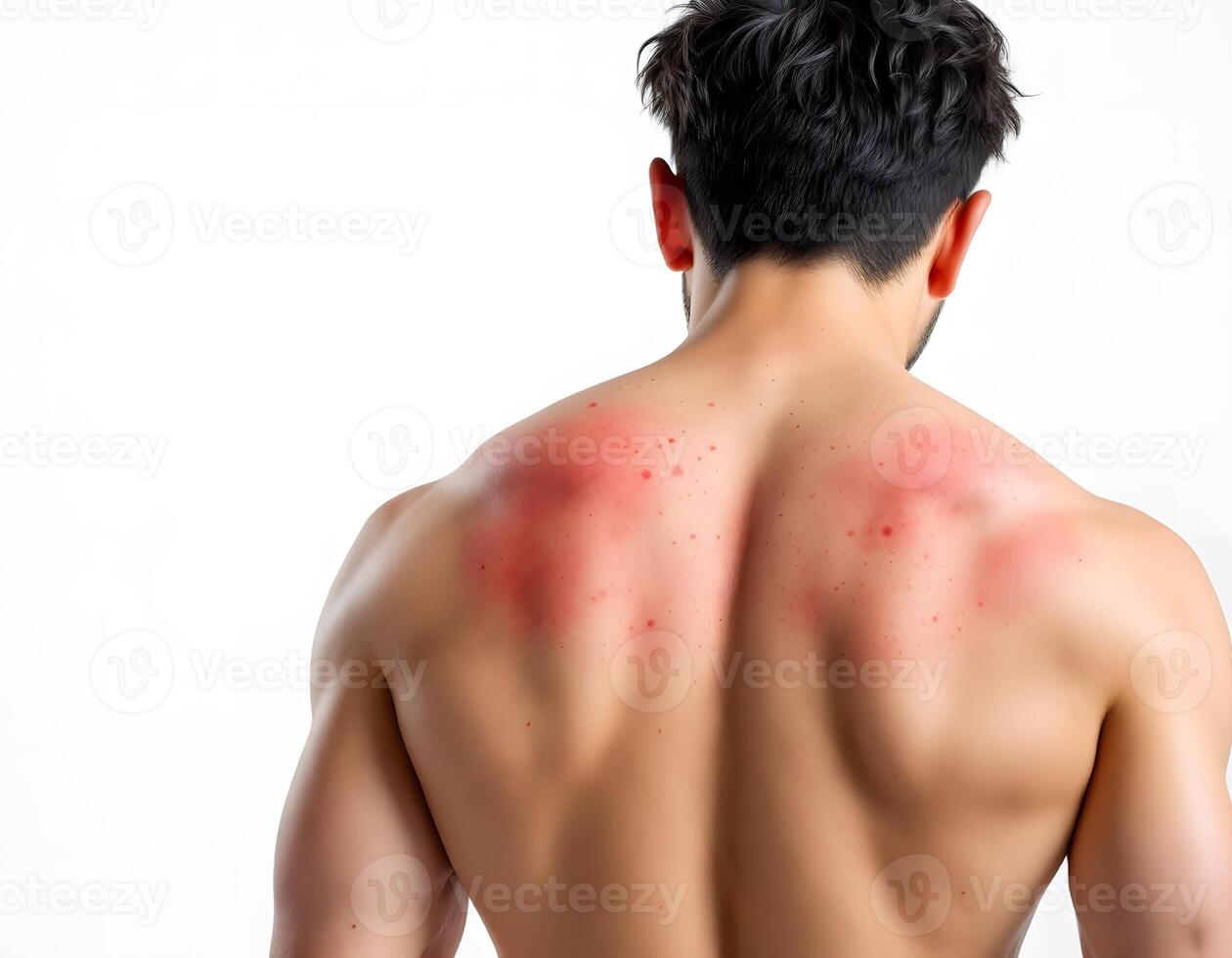 Man's Back with Sunburn, Red Skin Irritation, Healthcare, Dermatology, photo