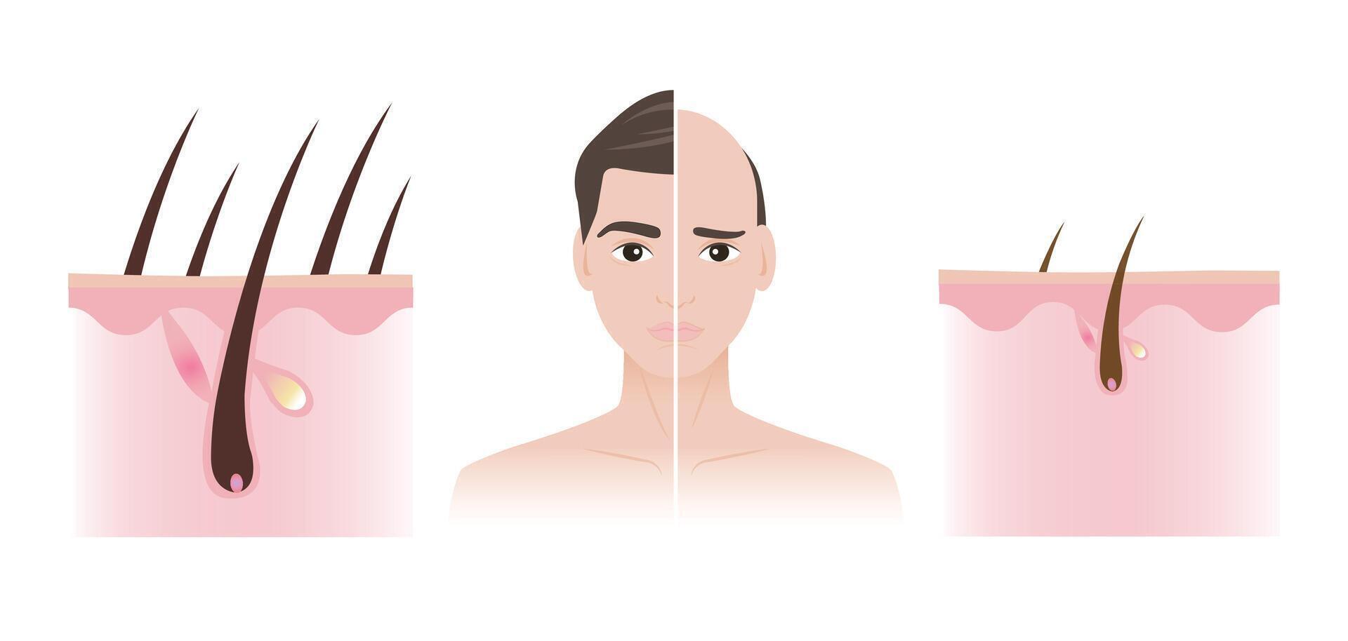 Comparison of man with thick hair and baldness illustration. The difference between healthy hair follicle and miniaturization with scalp layer. Male pattern baldness or androgenetic alopecia. vector