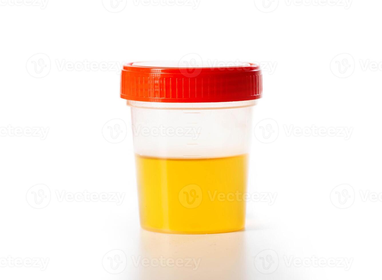 Urine analysis on a white background, isolate. Urine examination in urology for cystitis and pyelonephritis. Bacteria and leukocytes in urine, close-up photo