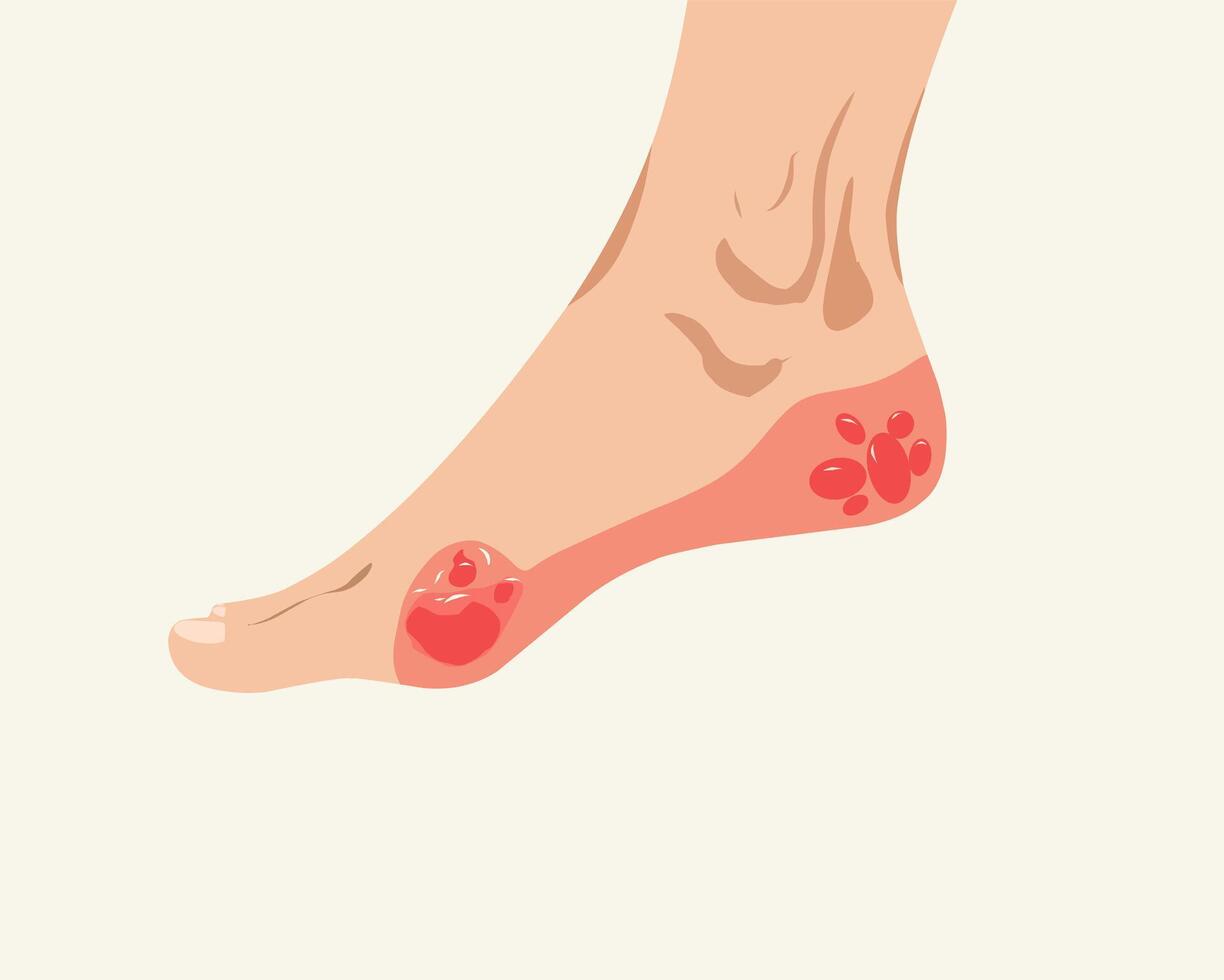 illustration of a diabetic foot with ulcers and infection. Medical concept depicting complications of diabetes, neuropathy, and poor circulation in the feet. vector