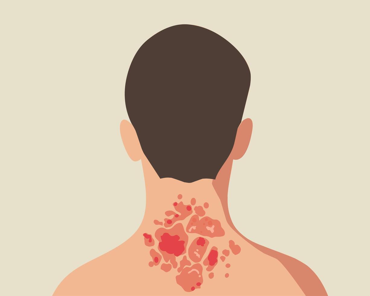 Illustration of psoriasis on the nape of a man. Depicts scaly, red, and inflamed skin. Ideal for medical, dermatology, and health related designs vector