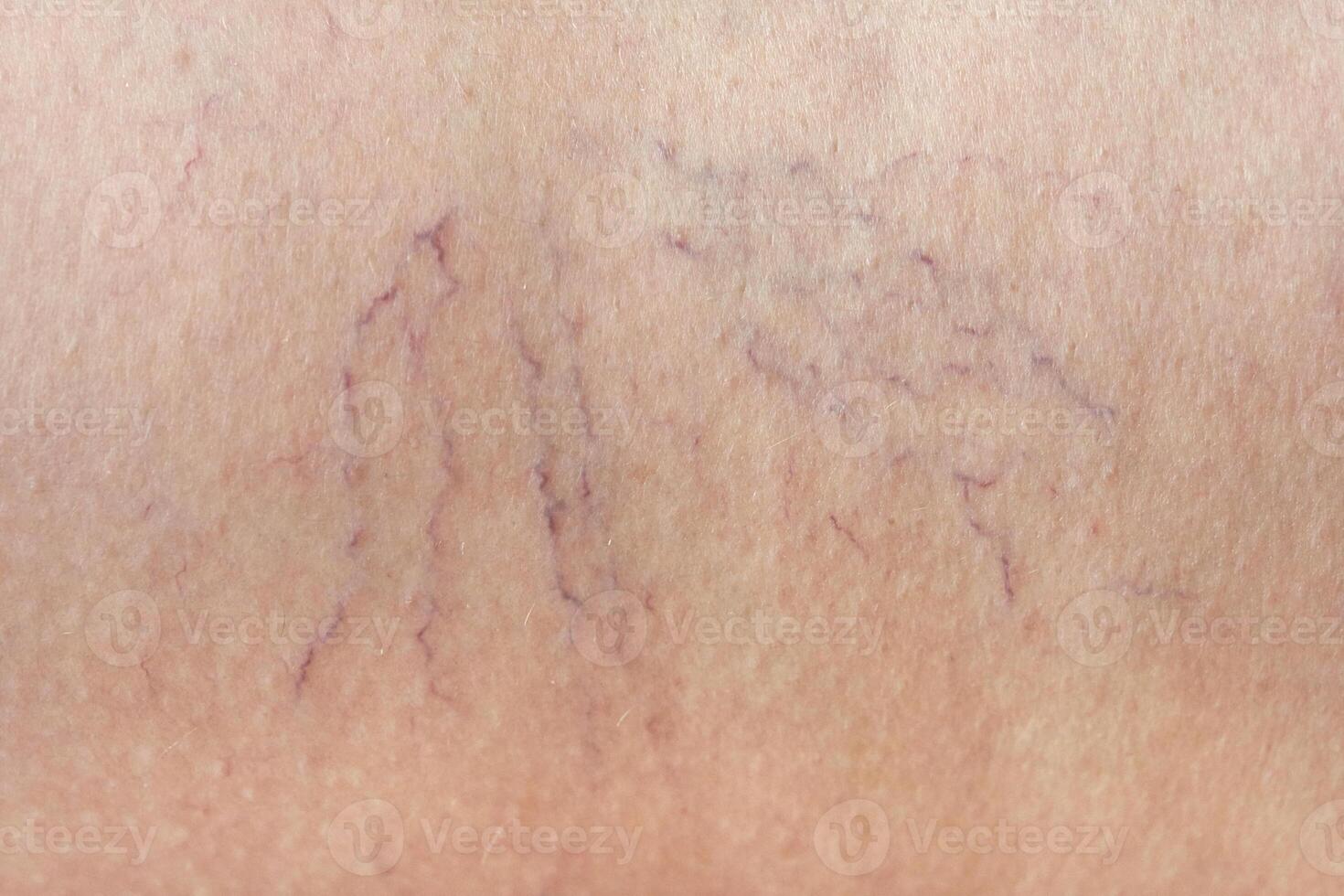 Close up of visible varicose veins on human skin showing vascular condition with prominent surface veins. photo