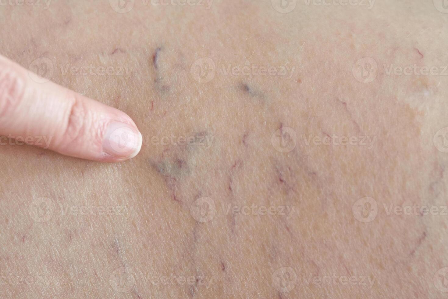 Close up of finger pointing to varicose veins on skin surface. photo