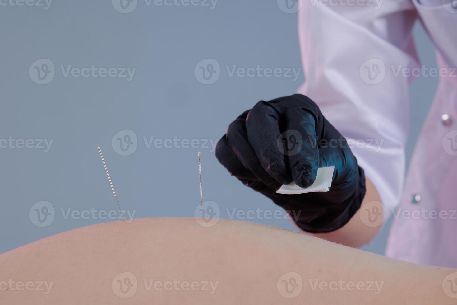 Close-up of a dry needling session where a practitioner inserts thin needles into a patient's back. Traditional Chinese medicine acupuncture to relieve photo