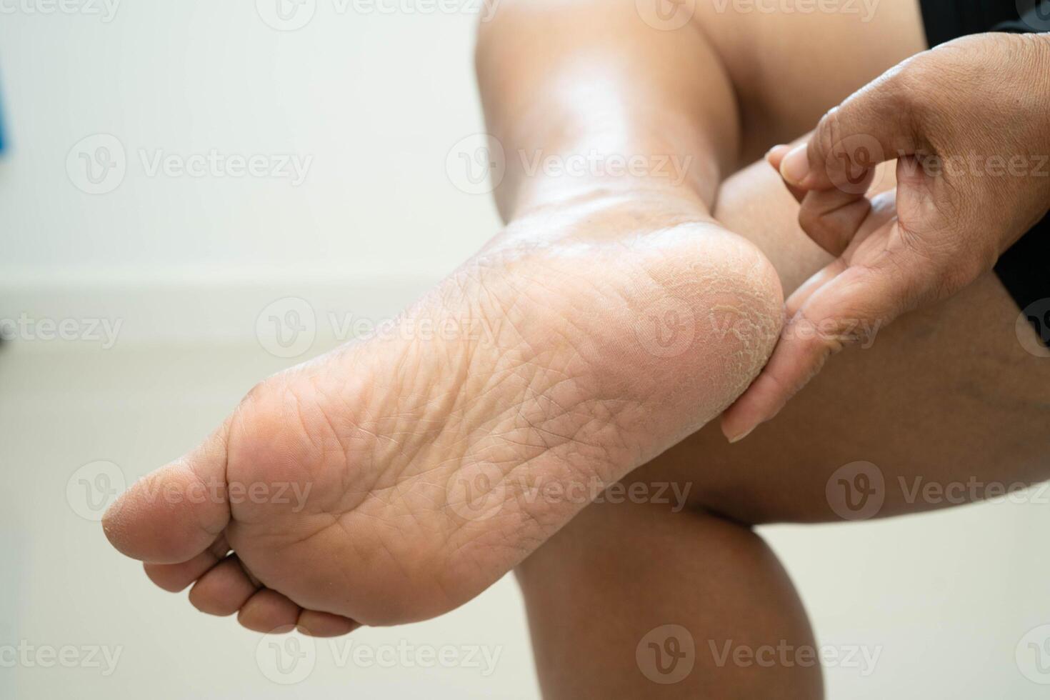 Asian woman check feet with crack and dry heel skin, photo