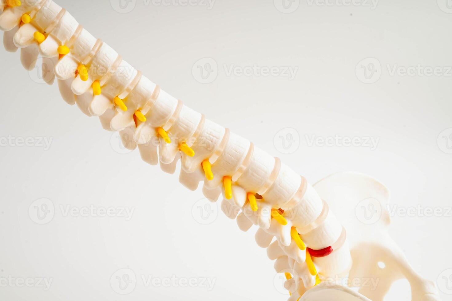 Spinal nerve and bone, Lumbar spine displaced herniated disc fragment, Model for treatment medical in the orth photo