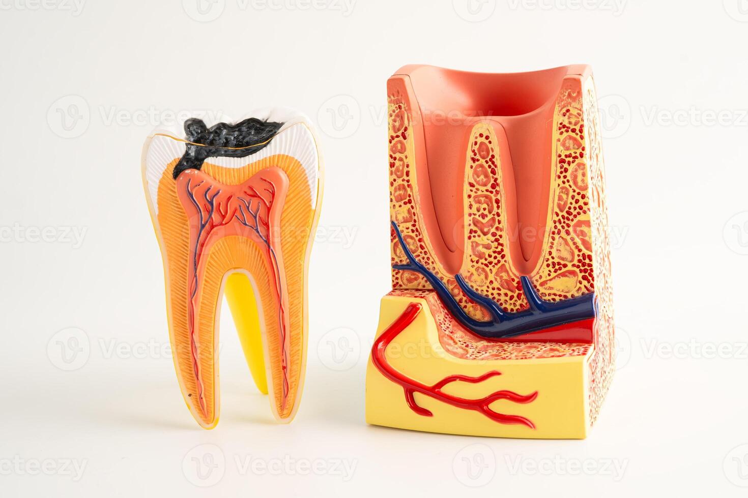 Dental implant, artificial tooth roots into jaw isolated on white photo