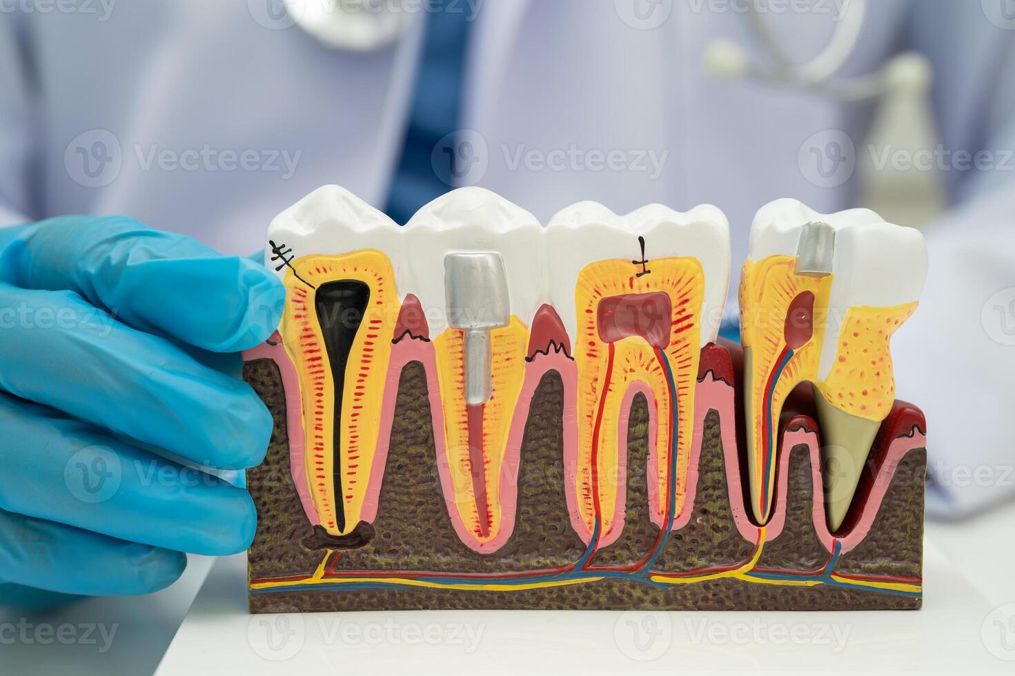 Dental implant, artificial tooth roots into jaw, root canal of dental treatment, gum photo
