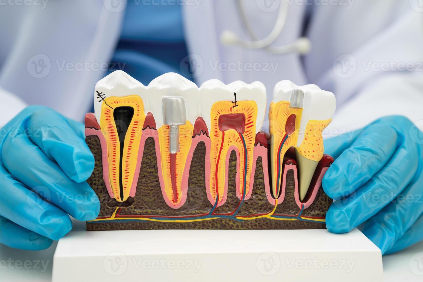 Dental implant, artificial tooth roots into jaw, root canal of dental treatment, gum disease photo