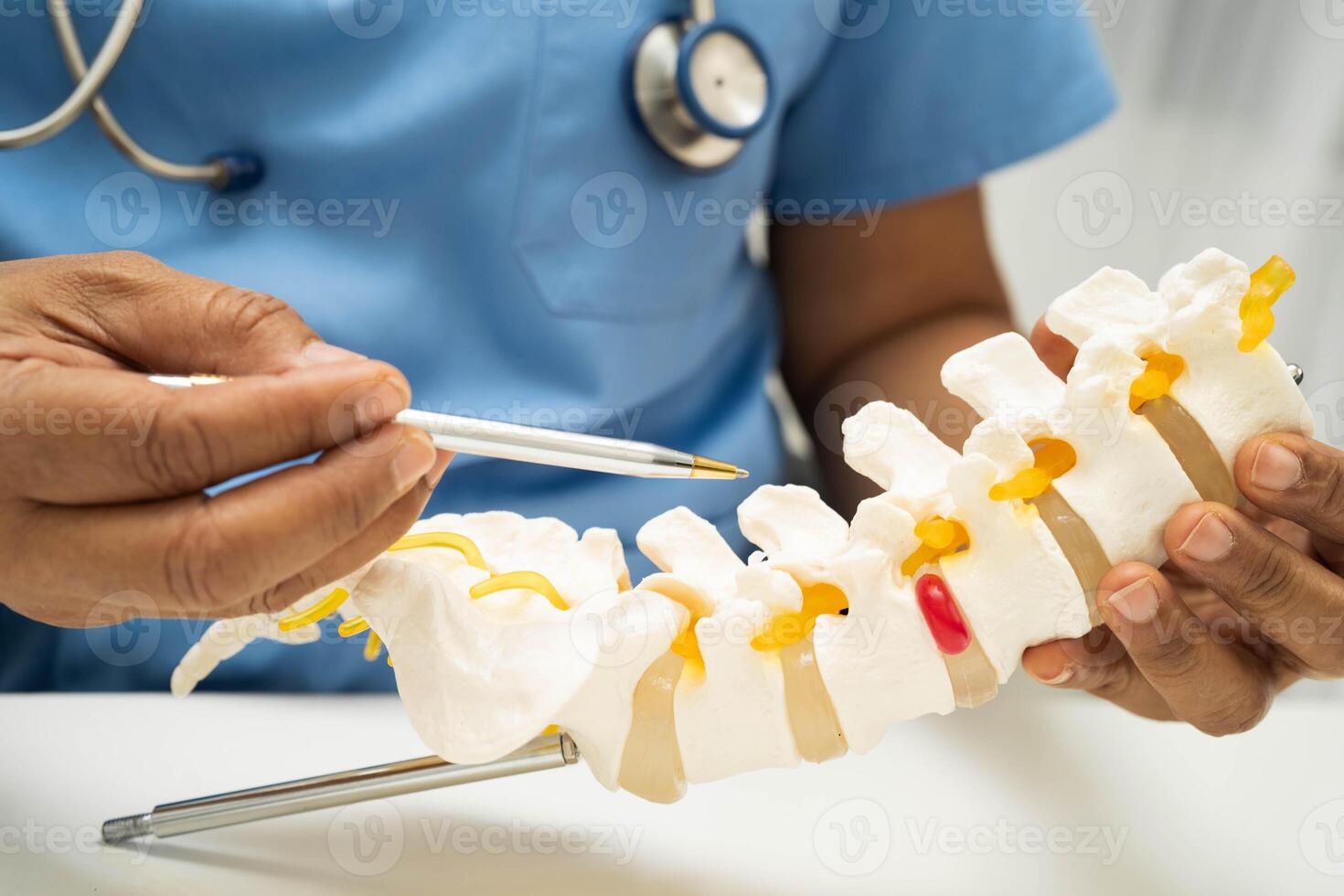 Asian doctor holding spinal nerve and bone model, Lumbar spine displaced herniated disc fragment photo