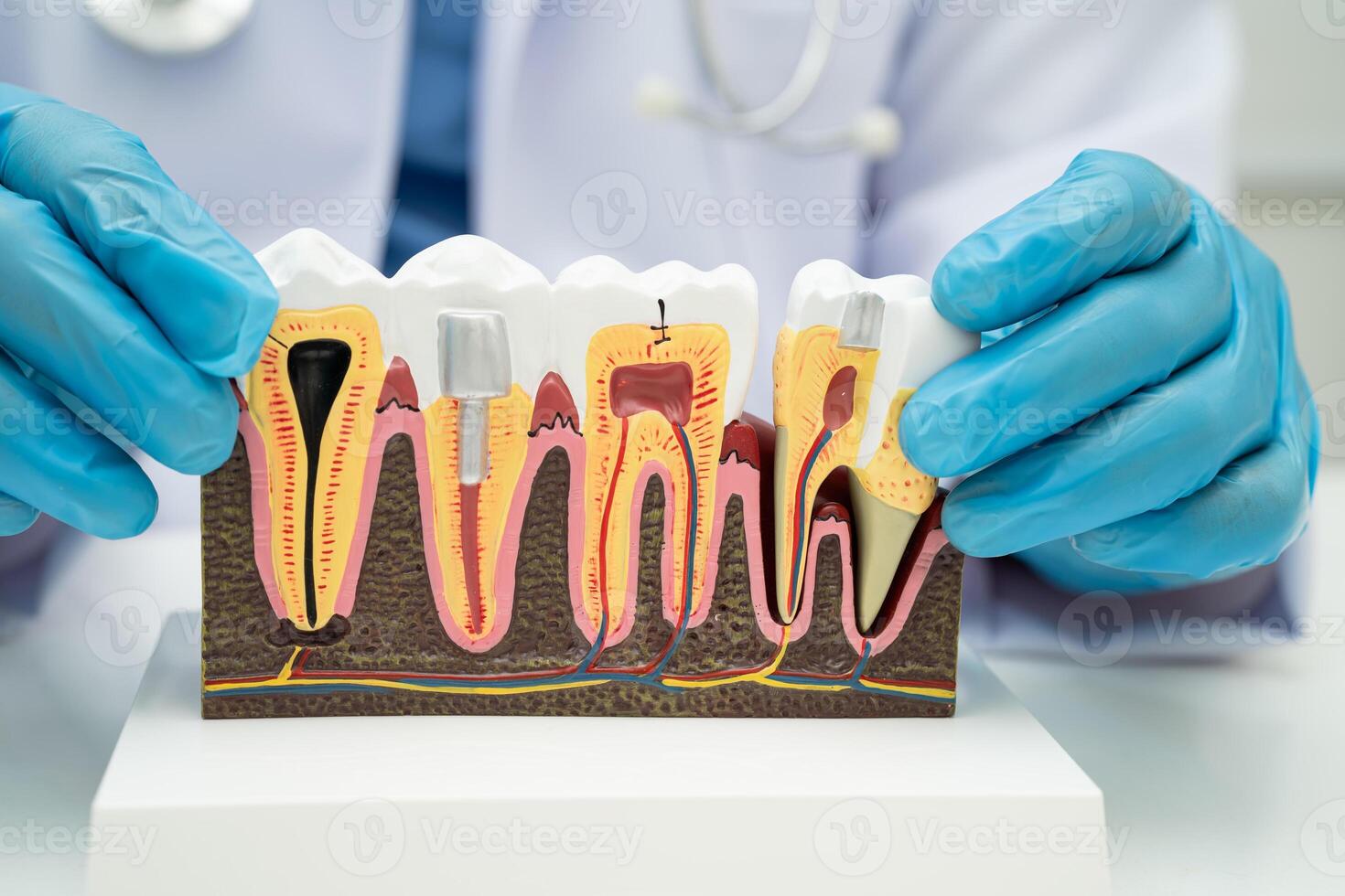 Dental implant, artificial tooth roots into jaw, root canal of dental treatment, gum disease, teeth model for dentist studying photo