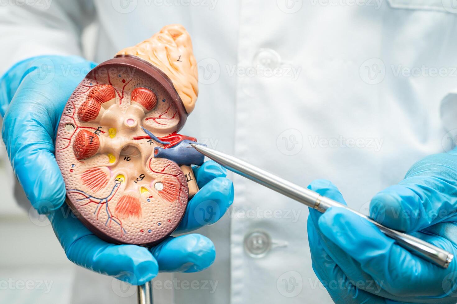 Kidney disease, Chronic kidney disease ckd photo