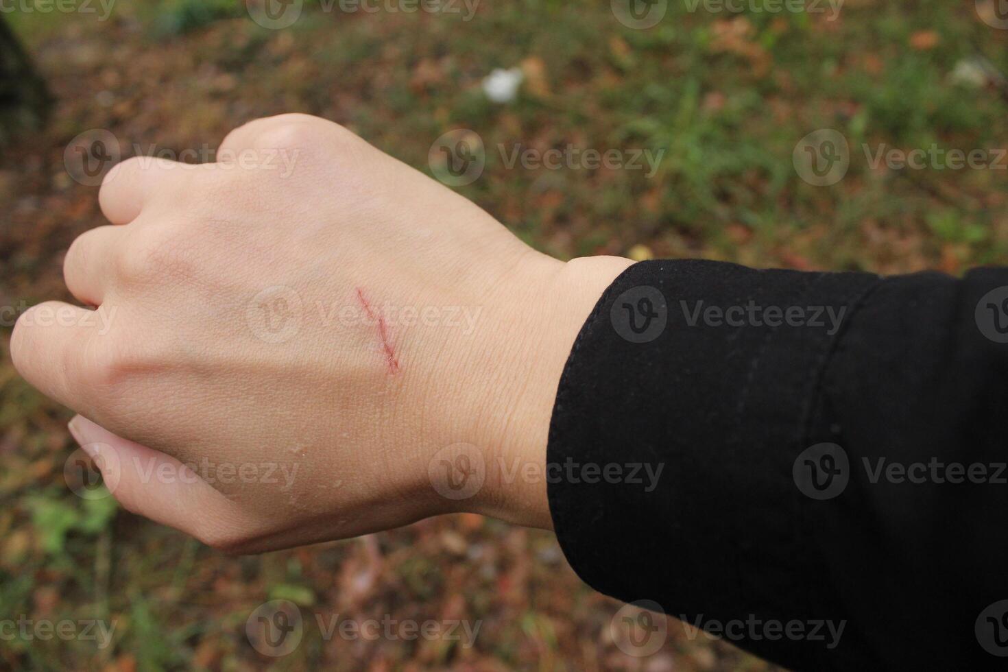 Close up scratch on hand of the back of a young woman's girl's hand. Skin injuries photo