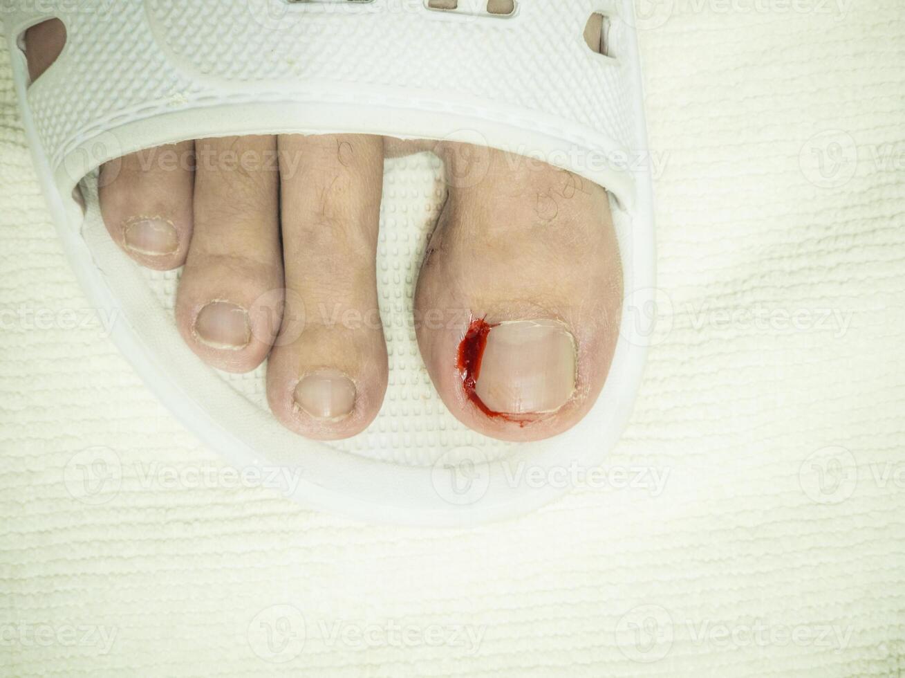 bleeding toe caused by a torn hangnail photo