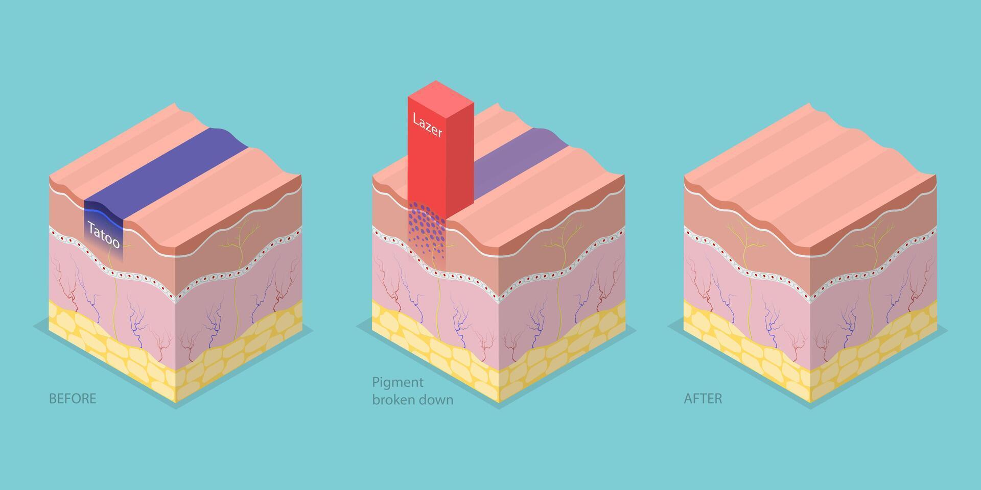 3D Isometric Flat Conceptual Illustration of Laser Tattoo Removing, Cosmetic Dermatology vector