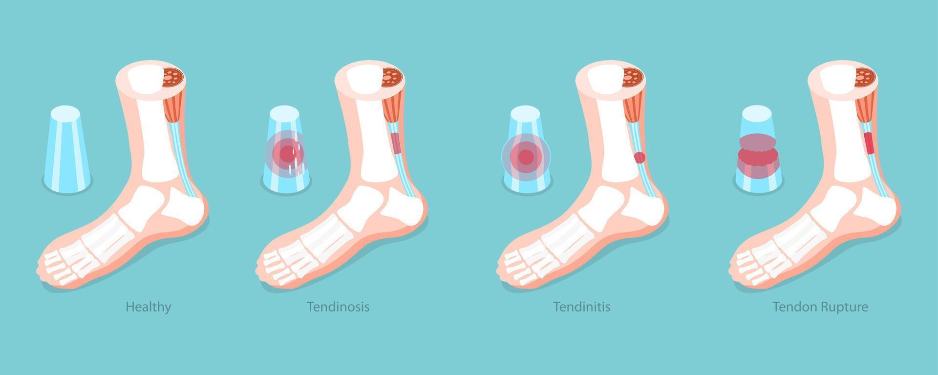 3D Isometric Flat Conceptual Illustration of Achilles Tendon, Tendinitis Problem vector