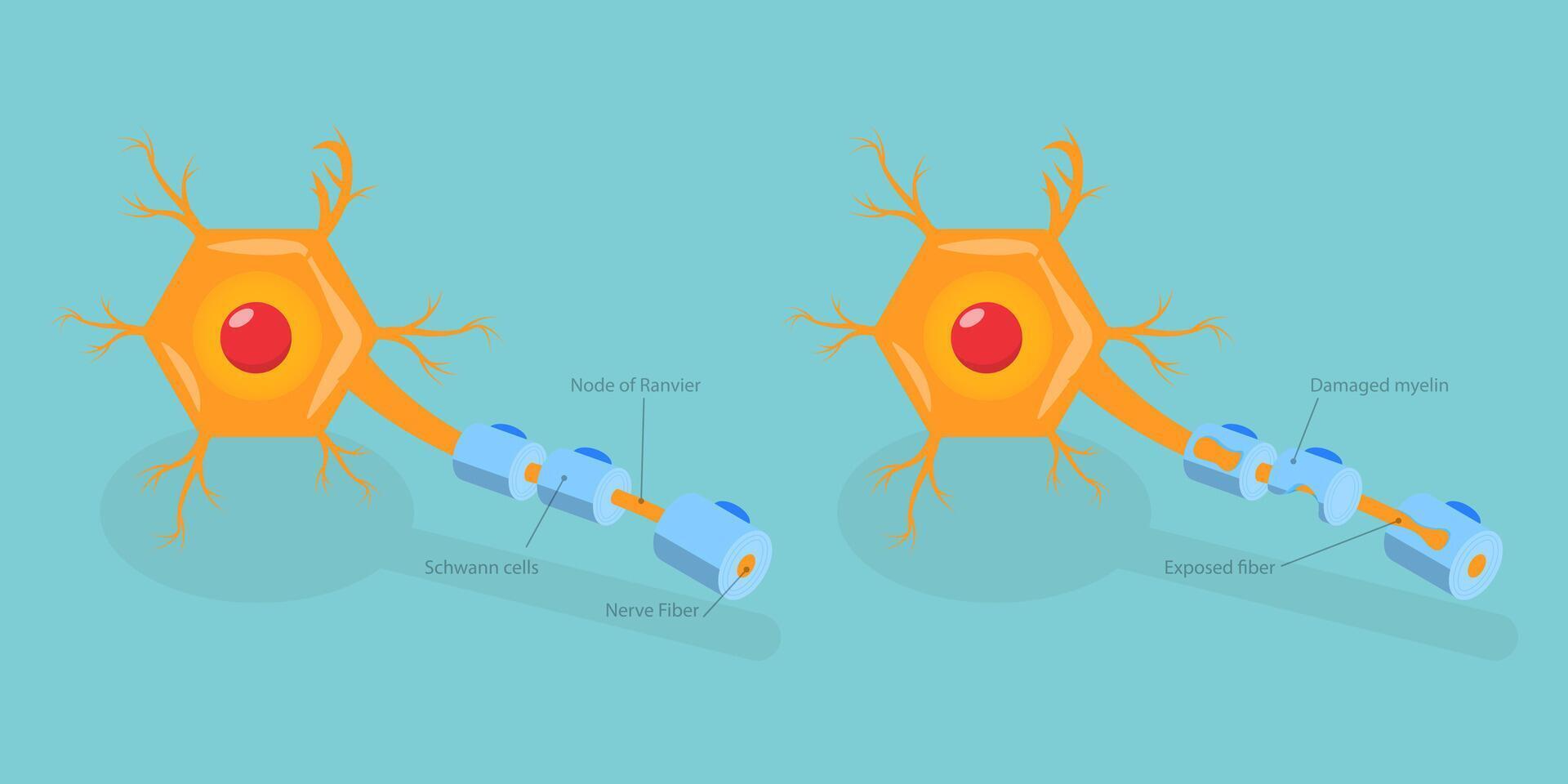 3D Isometric Flat Conceptual Illustration of Multiple Sclerosis, Demyelinating Disease vector