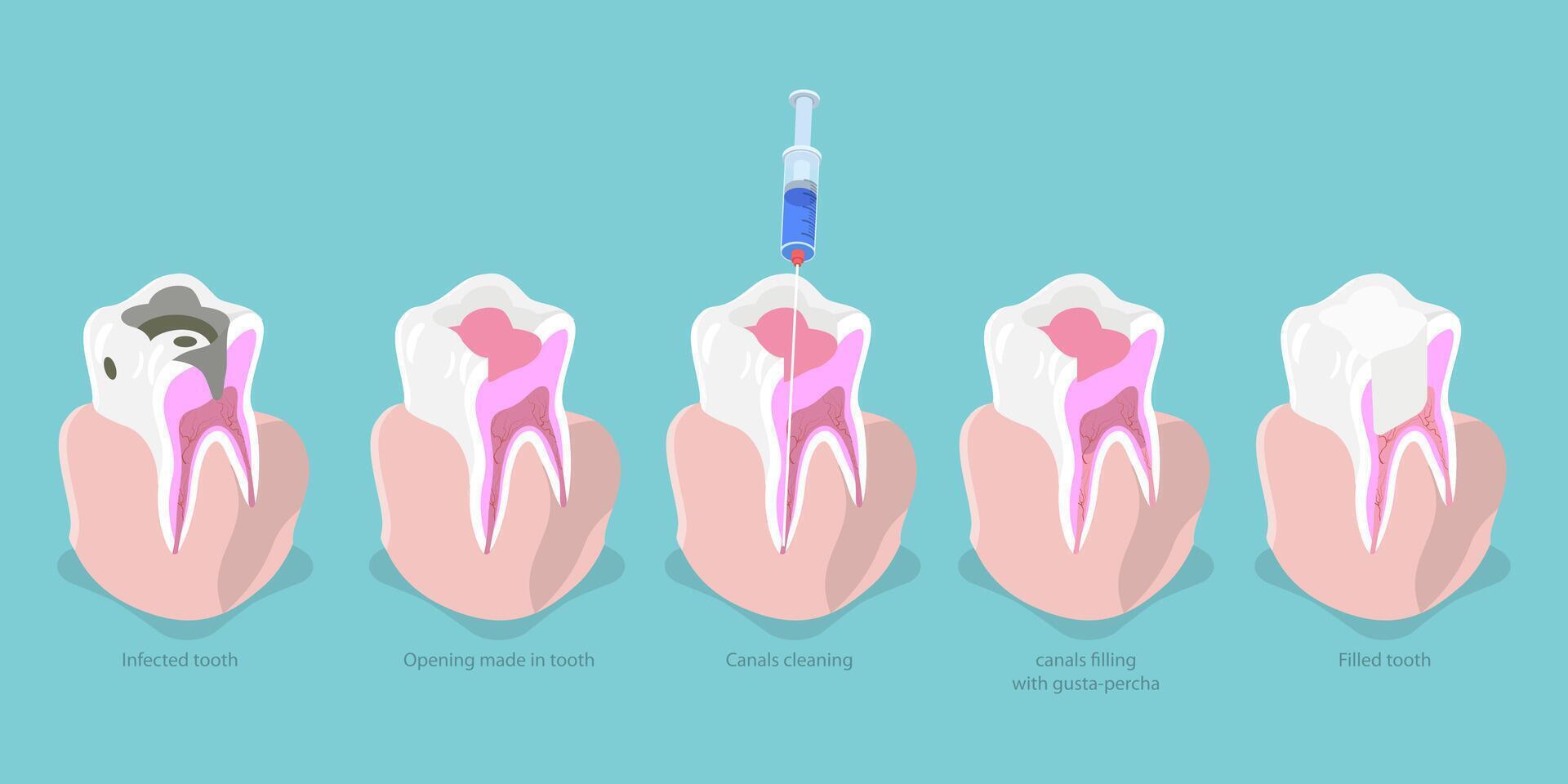 3D Isometric Flat Conceptual Illustration of Tooth Decay, Root Canal Treatment Chart vector