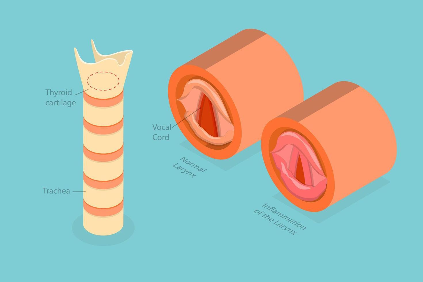 3D Isometric Flat Conceptual Illustration of Laryngitis, Voice Disorder vector