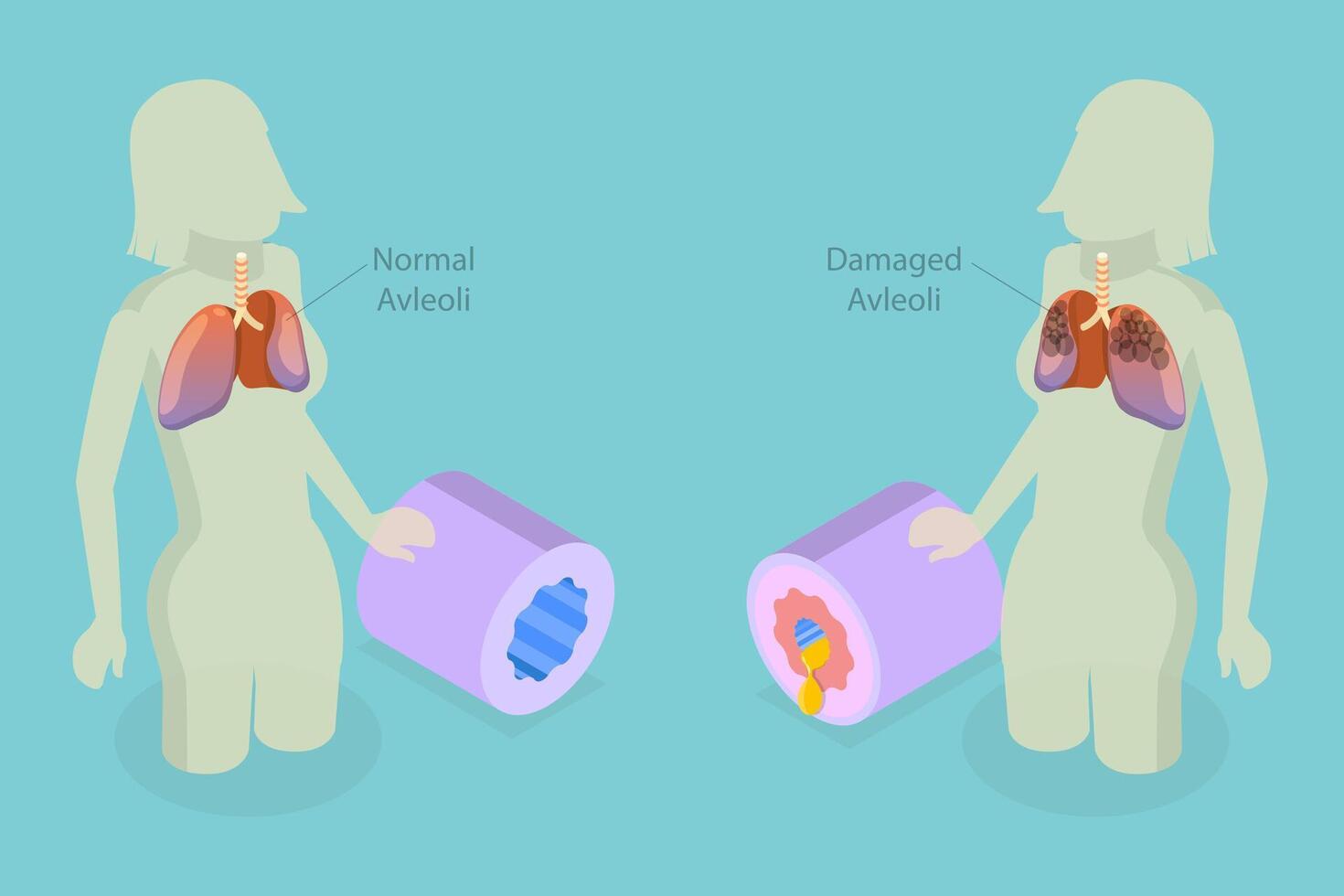 3D Isometric Flat Conceptual Illustration of Chronic Obstructive Pulmonary Disease , COPD vector