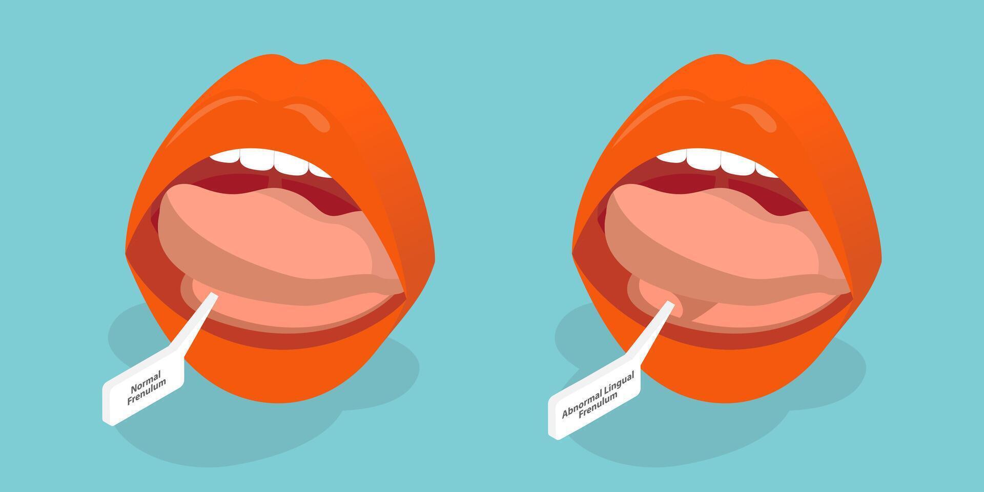3D Isometric Flat Conceptual Illustration of Ankyloglossia, Short Lingual Frenum That Interferes with Normal Tongue Movement. vector