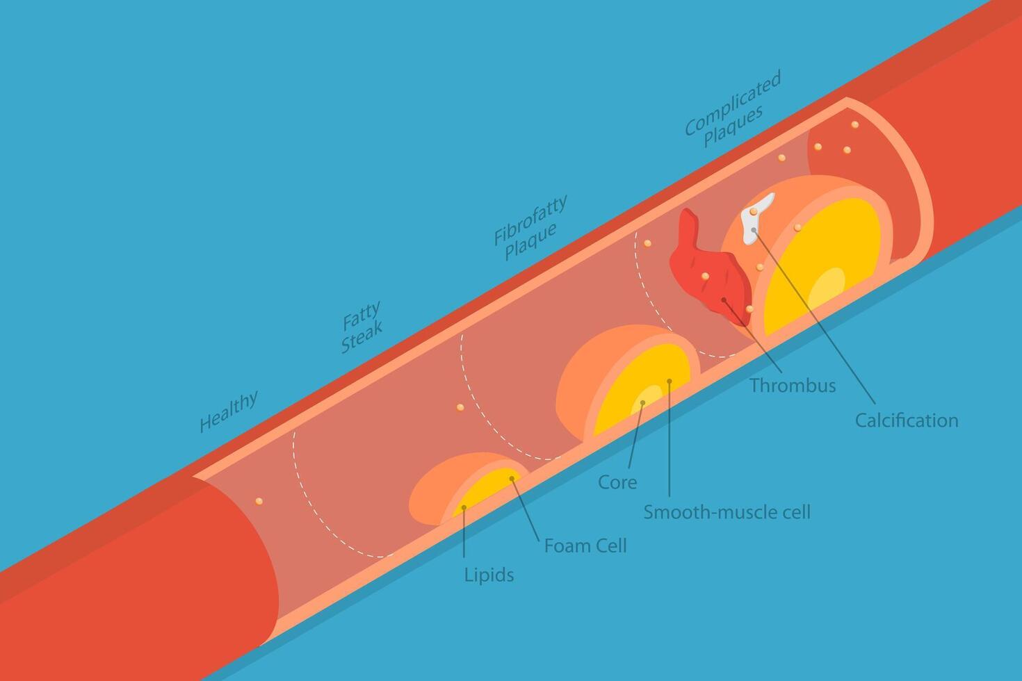 3D Isometric Flat Conceptual Illustration of Stage Of Atherosclerosis, Cardiovascular Disease vector