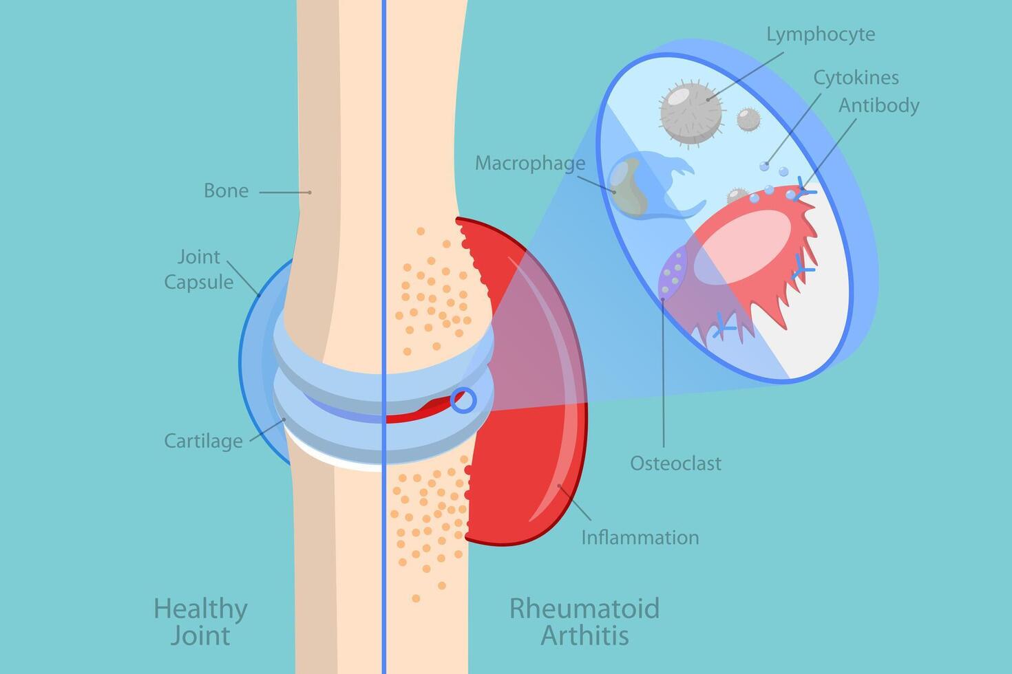 3D Isometric Flat Conceptual Illustration of Rheumatoid Arthritis, Bones Pain, Injury and Inflammation vector