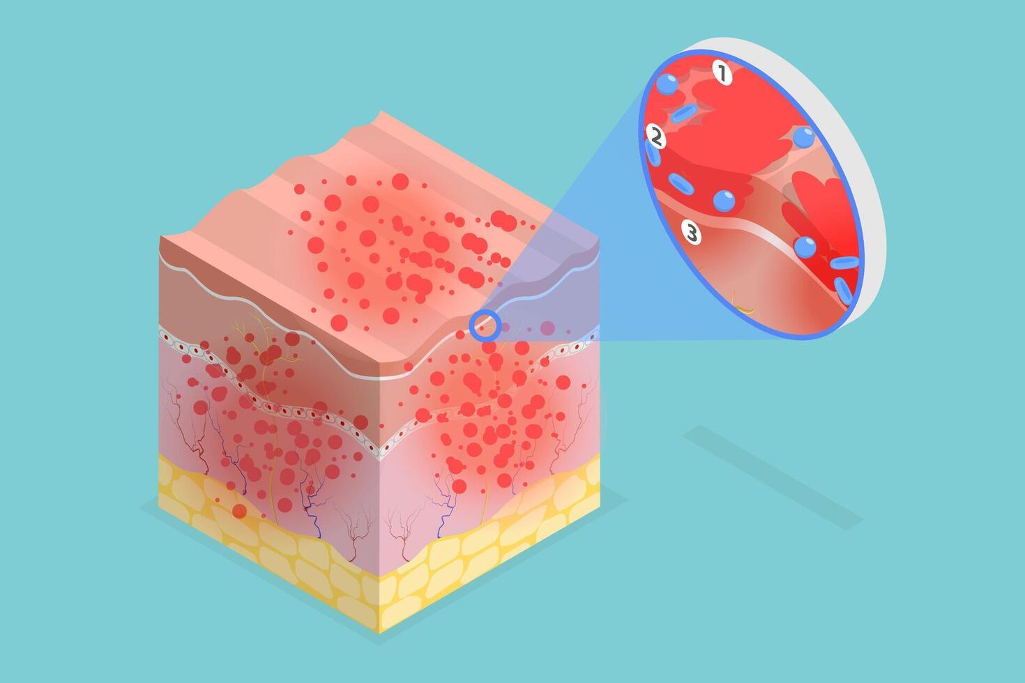 3D Isometric Flat Conceptual Illustration of Atopic Dermatitis, Eczema Symptoms vector