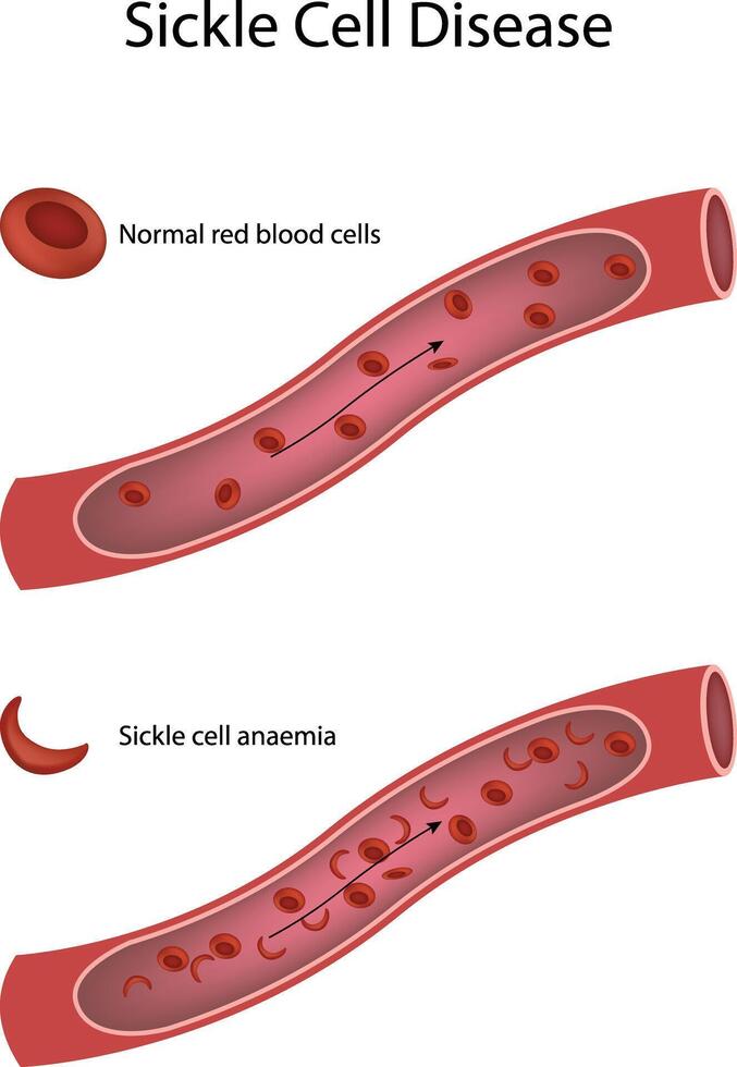 Comparison of normal red blood cells and sickle cell anaemia in blood vessels Illustration vector