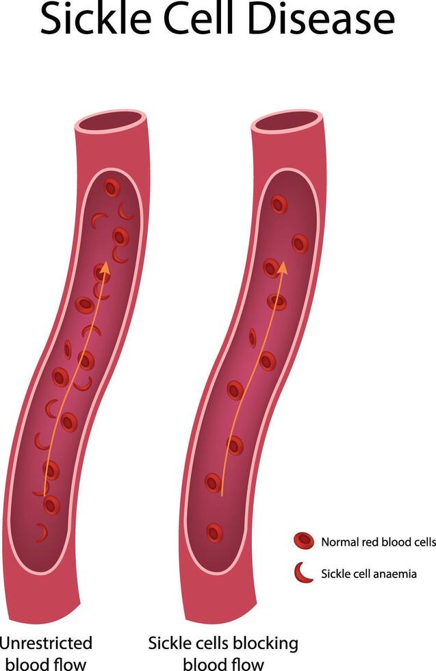 Sickle Cell Disease Normal vs Sickle Cell Anemia Blood Flow Illustration vector