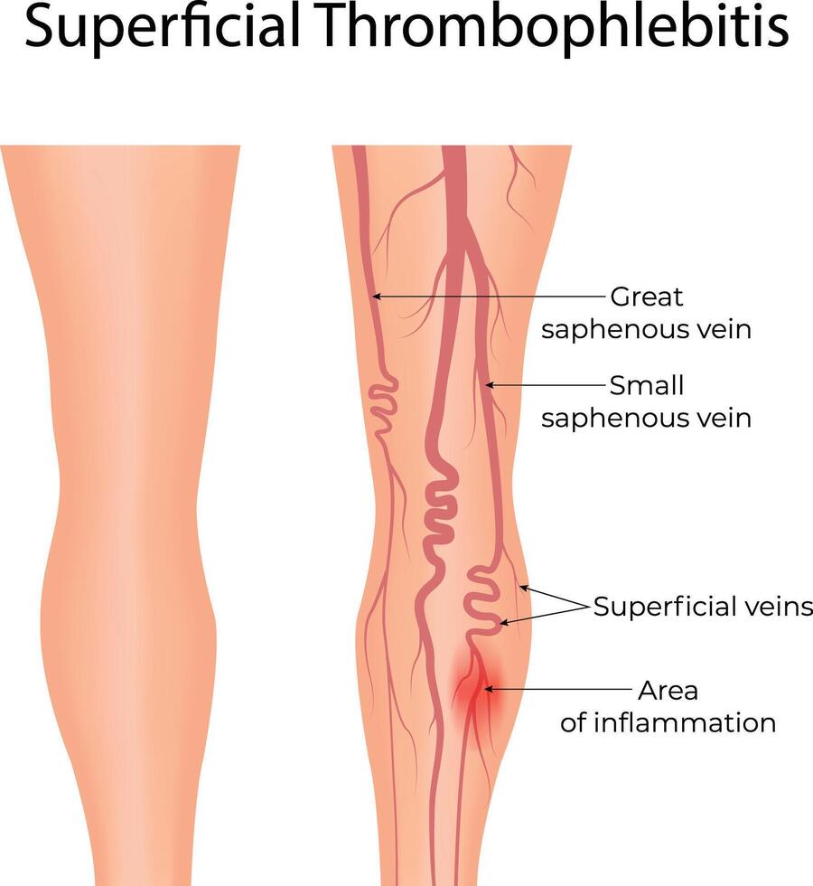Superficial Thrombophlebitis A Medical Illustration of Vein Inflammation in the Leg vector