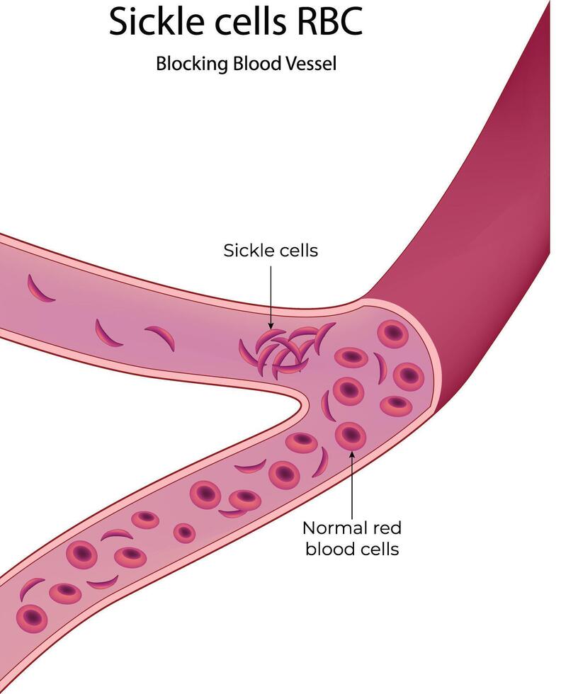 Illustration of sickle cells blocking a blood vessel Illustration vector