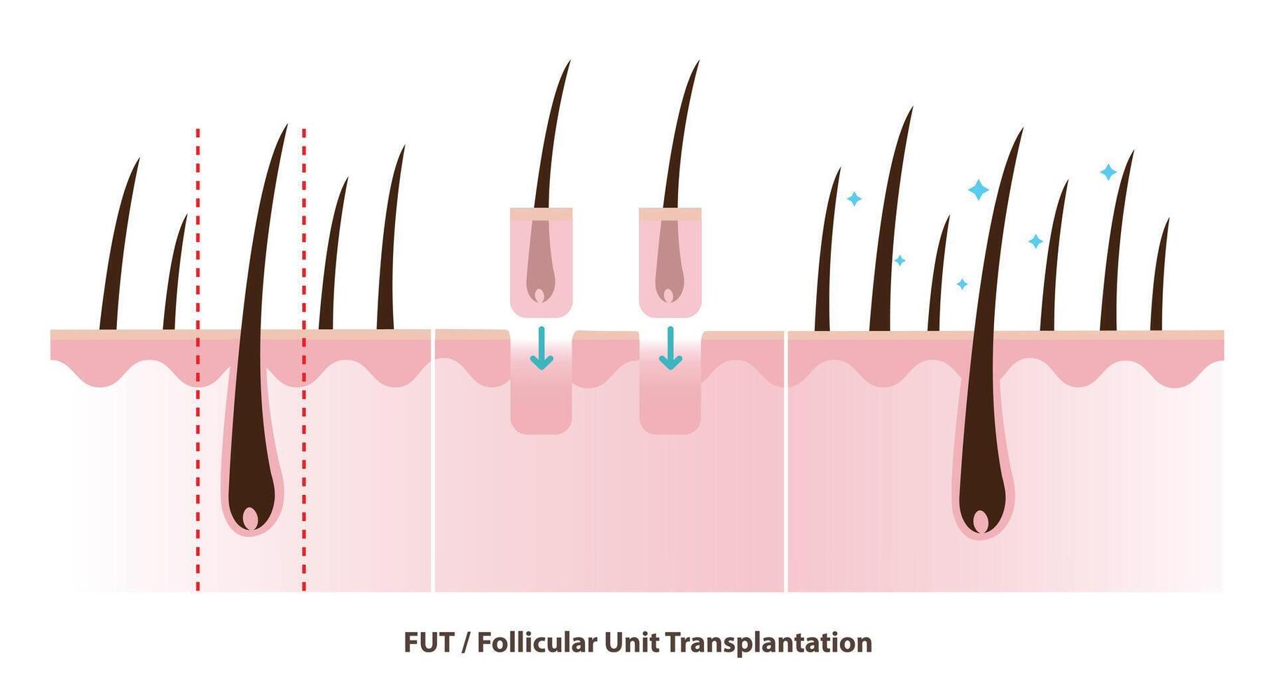 FUT hair transplant illustration. Follicular unit transplantation, surgical technique where strip of scalp from the donor area is removed, divided into small grafts, transplanted into the target area. vector