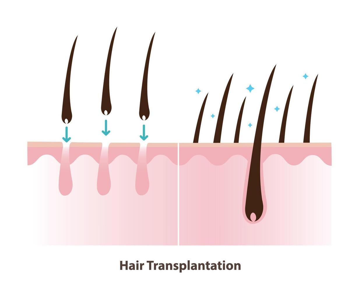 Before and after hair transplantation illustration. Permanent hair restoration, hair transplant surgery is procedure that moves hair follicles from a donor area to bald or thinning area of the scalp. vector