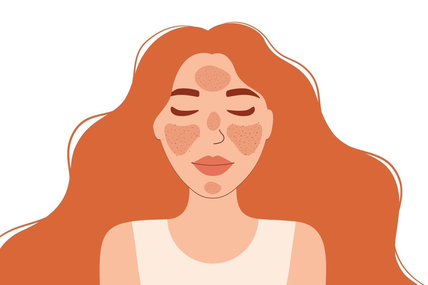 Woman with Rosacea illustration. The image highlights skin conditions such as rosacea, with visible red patches on the forehead, cheeks, and chin vector