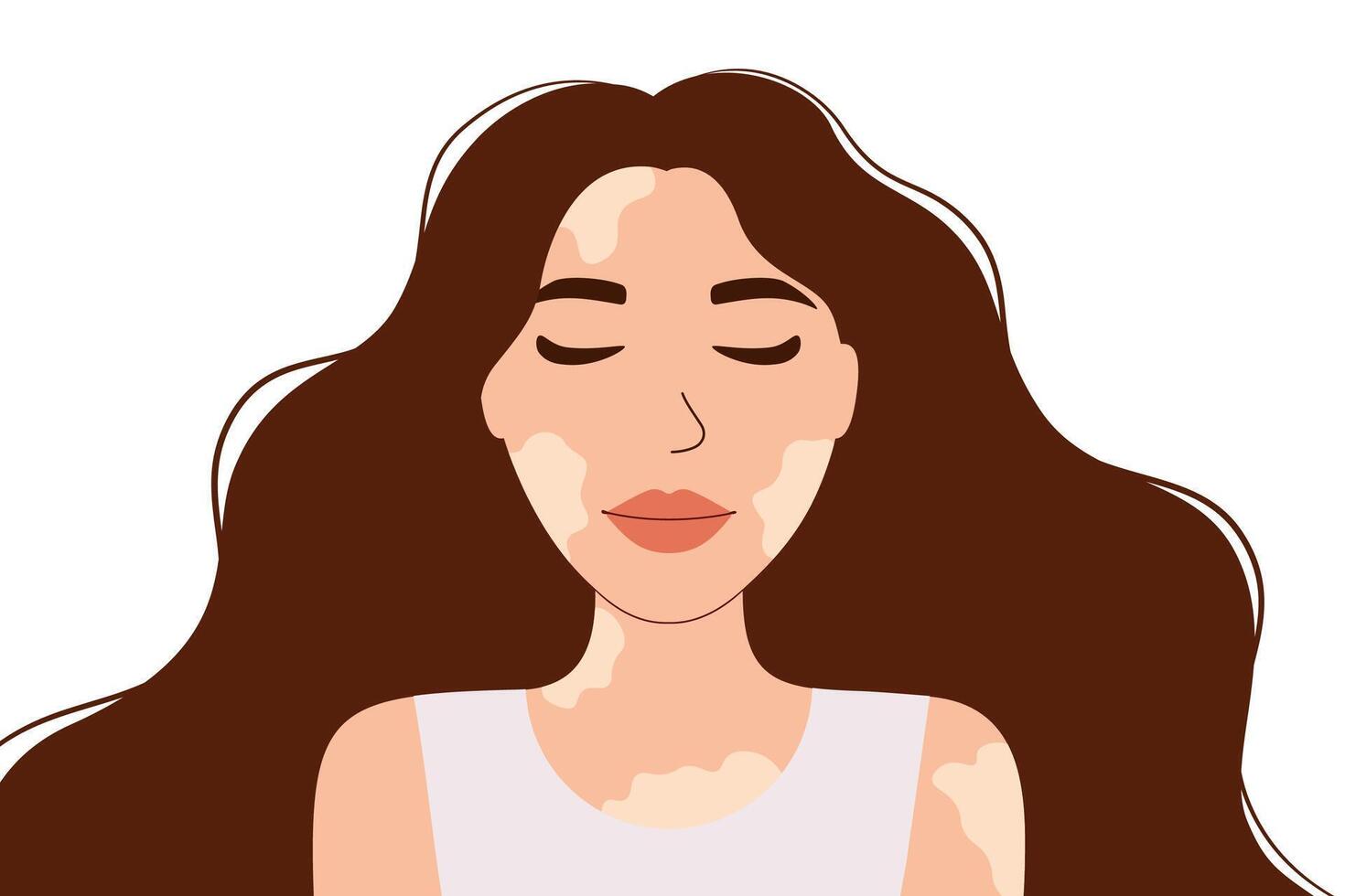 Beautiful woman with vitiligo skin. Body positivity and self acceptance. Skin condition illustration vector