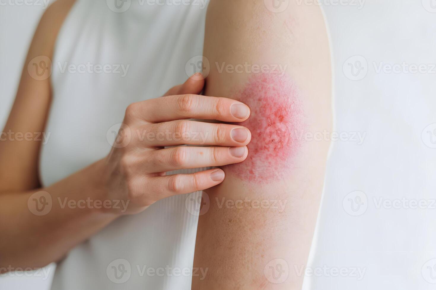 Persons arm with reddish pink irritation touched by fingers, suggesting skincare concern photo