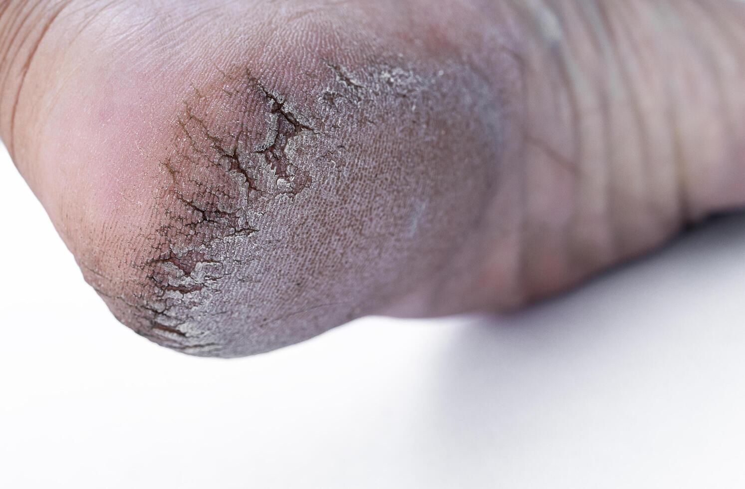 Close up crack heel further deep cracks and dry flaky skin photo