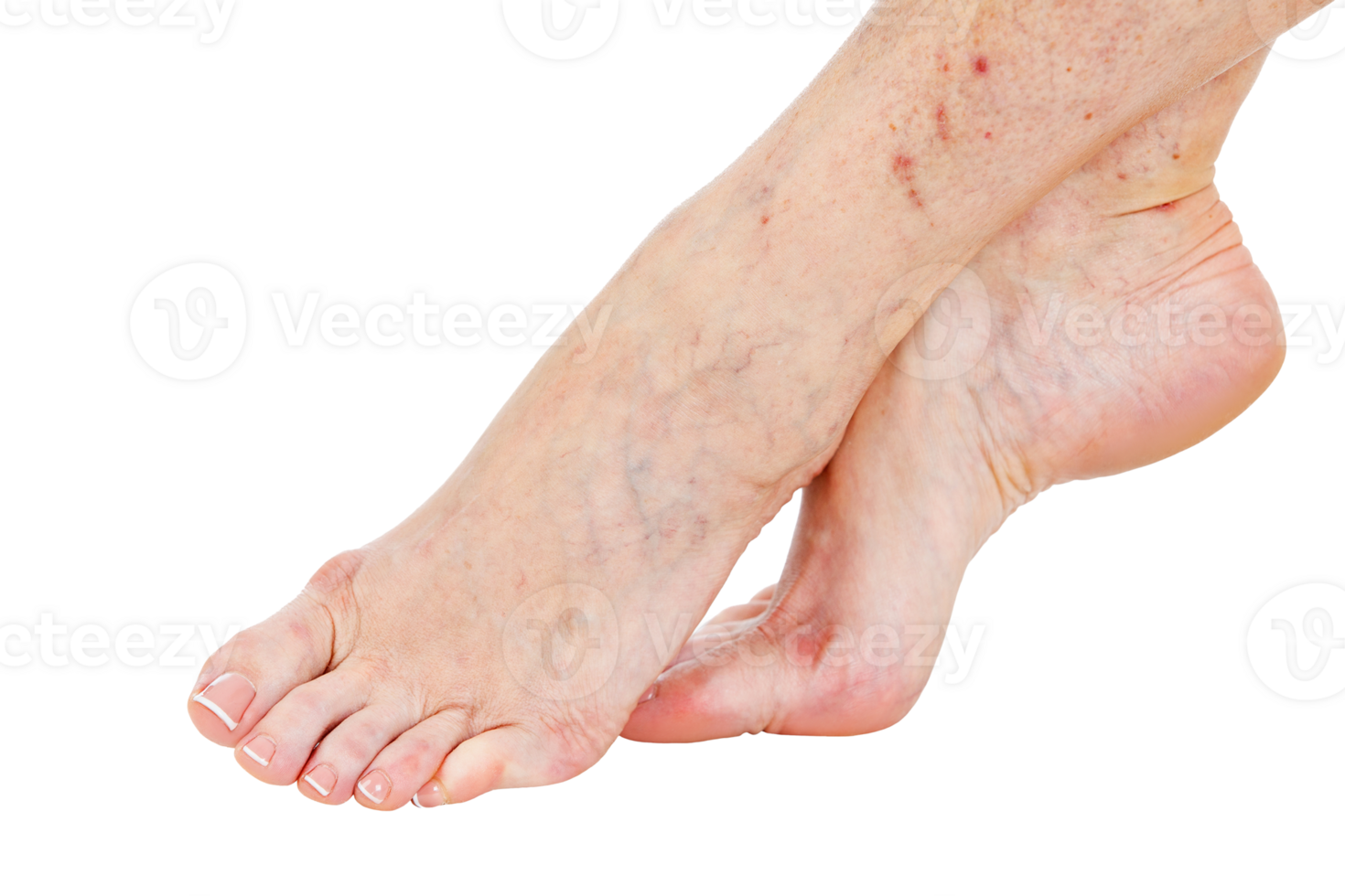Female feet with vascular stars and veins on the skin, isolated png